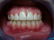 aparat na zęby warszawa