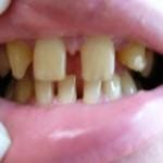 Implantologia stomatologiczna – uzupełnianie braków zębowych
