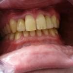 Implantologia stomatologiczna – uzupełnianie braków zębowych