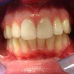 stłoczenia zębów spowodowane niewłaściwym noszeniem aparatu ruchomego - leczenie bez usuwania zebów