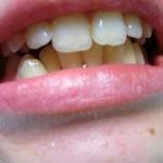 stłoczenia zębów spowodowane niewłaściwym noszeniem aparatu ruchomego -leczenie bez usuwania zebów