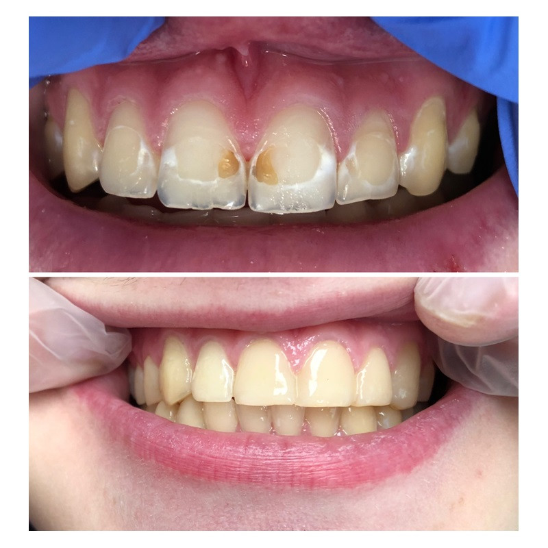zęby przed i po
